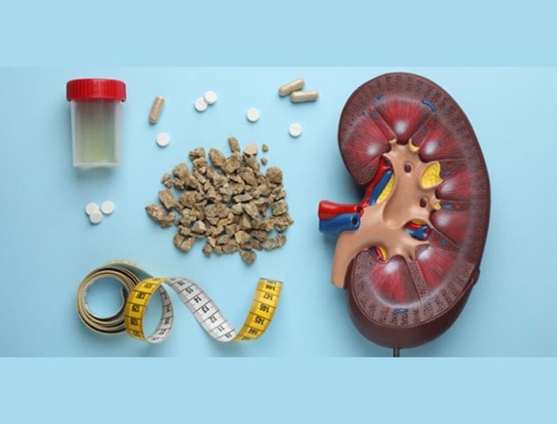 جدیدترین روش های خانگی و دارویی دفع سنگ کلیه