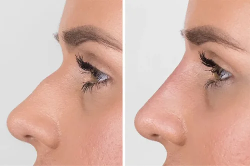 فیلر بینی و نکات ایمنی آن